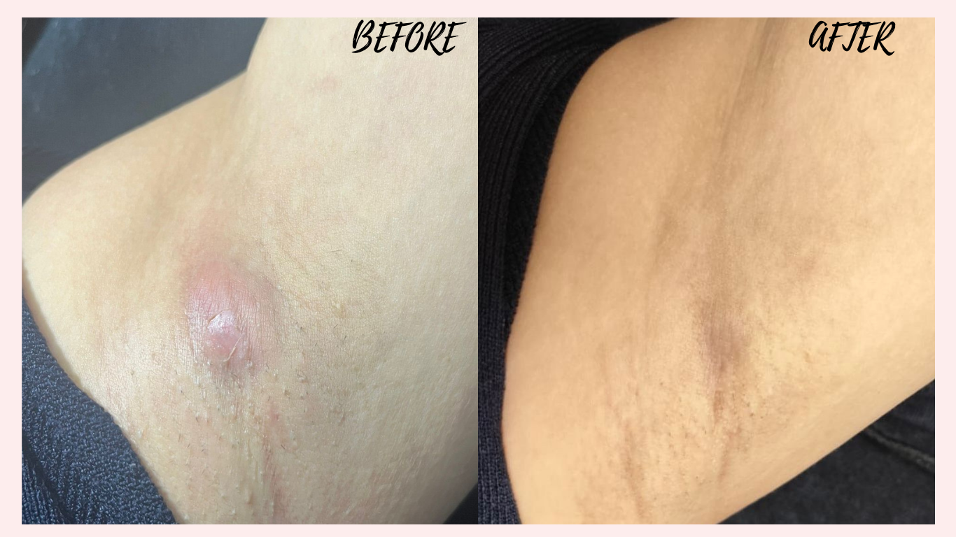 Plasma Treatment for Boil - Shugar Spa
