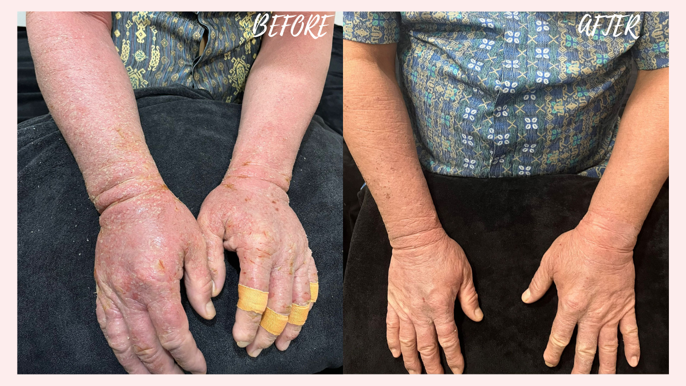 Plasma Treatment Before and After - Shugar Spa