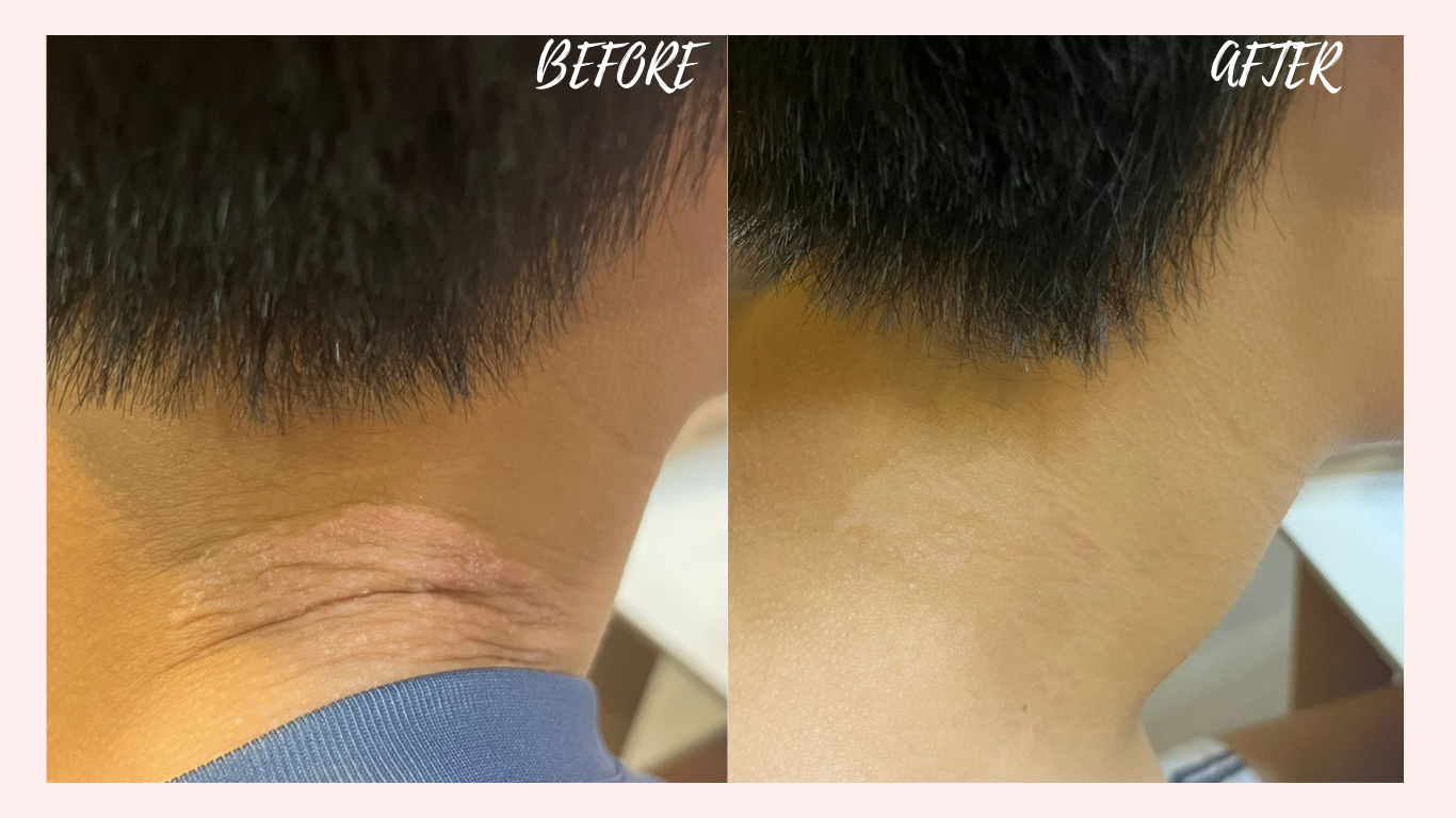 Plasma Treatment for Psoriasis - Shugar Spa